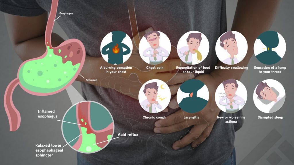 Symptoms of GERD and acid reflux