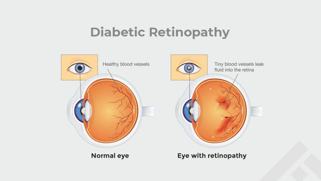 effect of diabetic retinopathy
