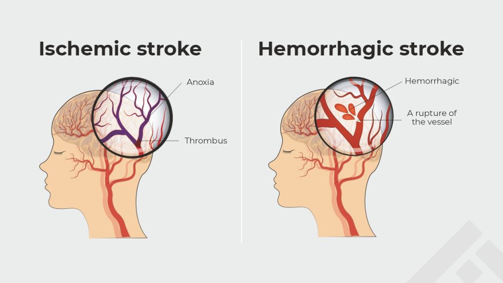 types of stroke