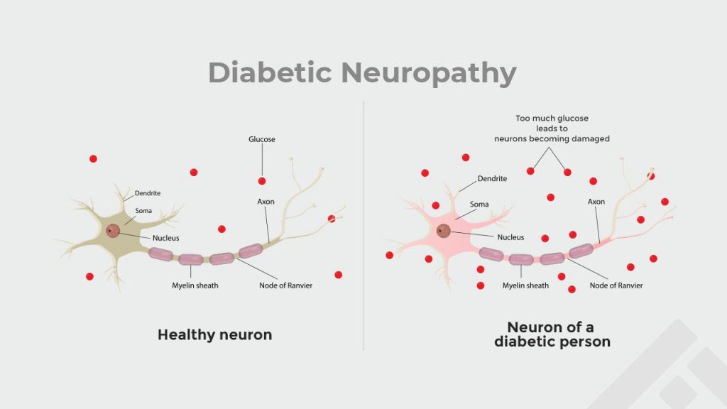 effect of diabetic neuropathy