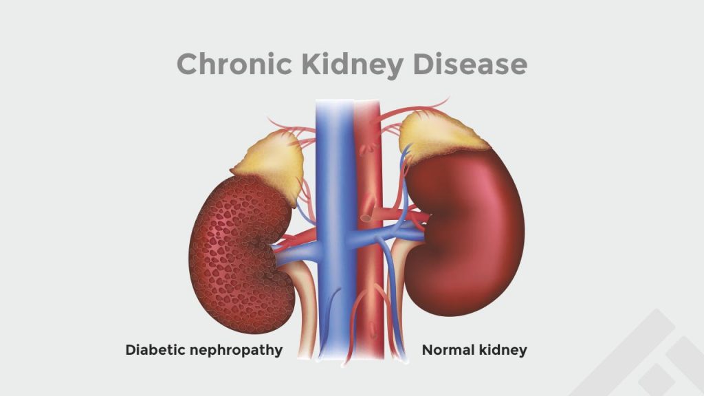 effect of diabetic nephropathy