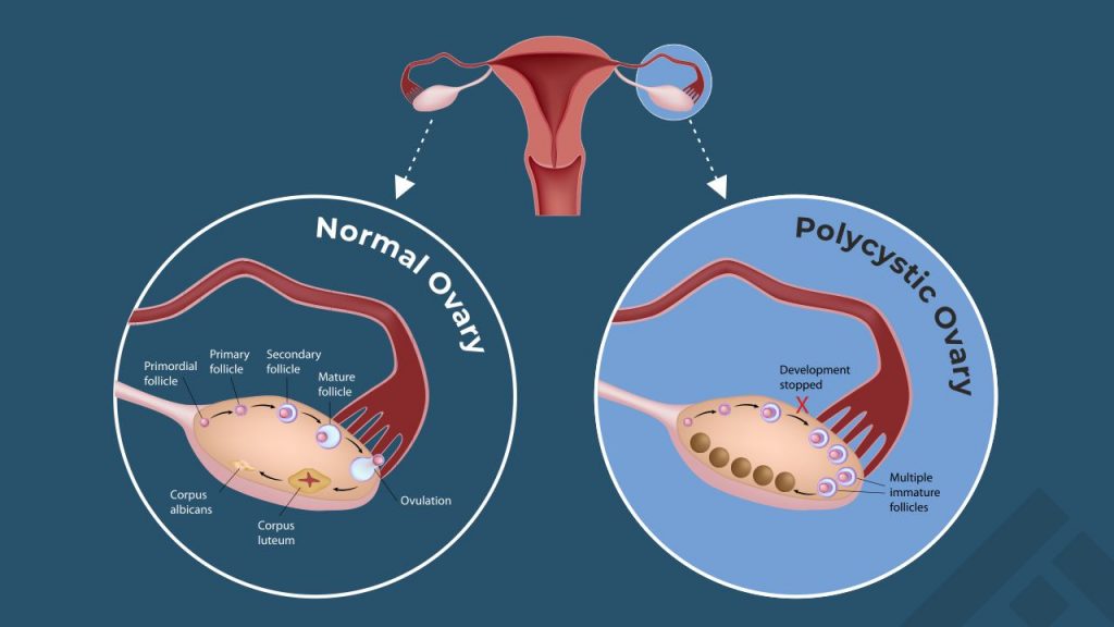 normal ovary vs PCOS ovary