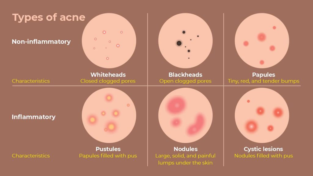 types of acne and their characteristics