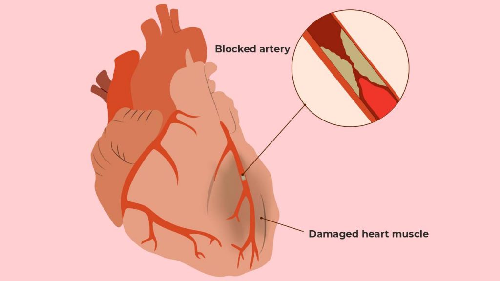 Coronary heart diseases (CHD) or ischemic heart disease (IHD)
