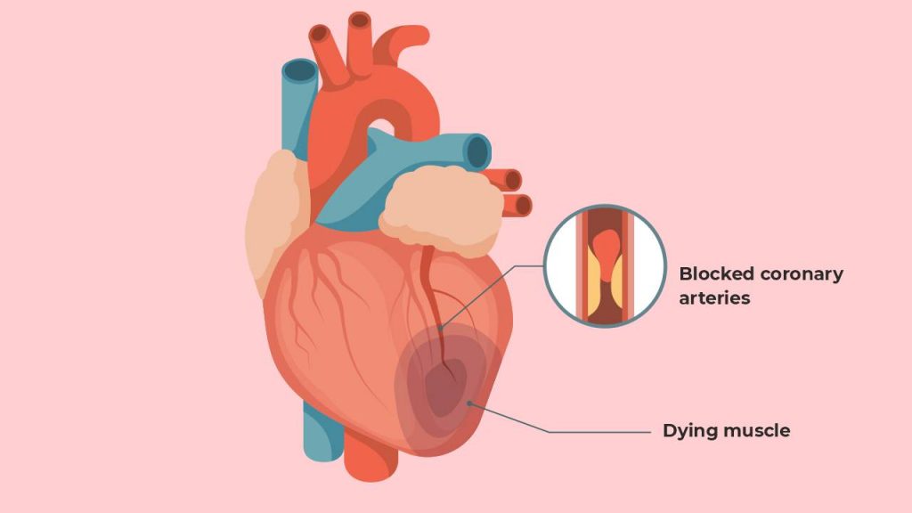 Myocardial infarction (heart attack)