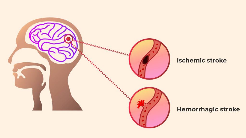 Ischemic and hemorrhagic stroke