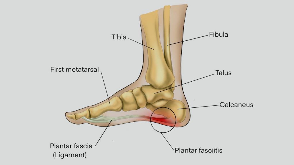 Plantar fasciitis: Inflammation in the plantar fascia