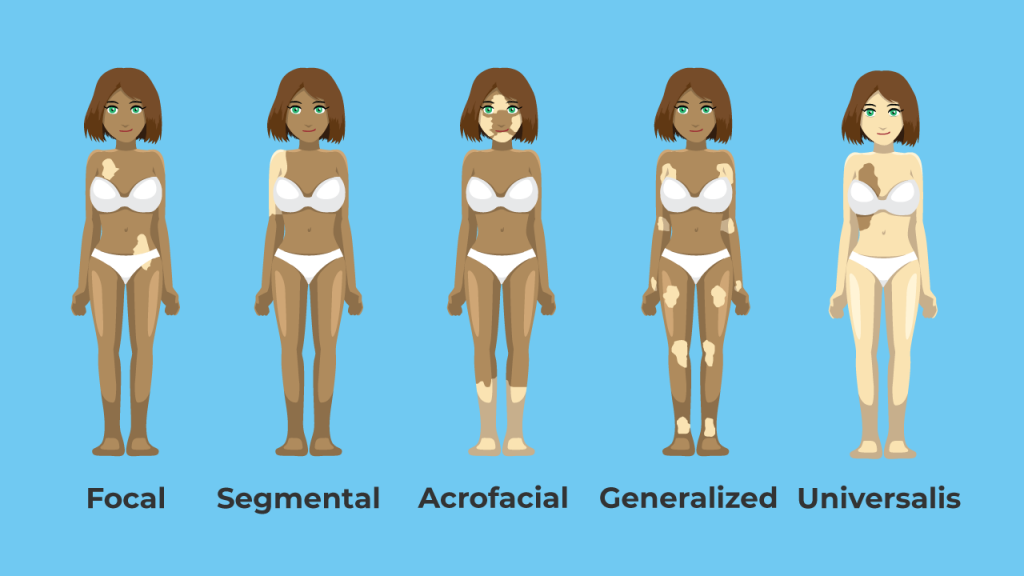 Types of vitiligo