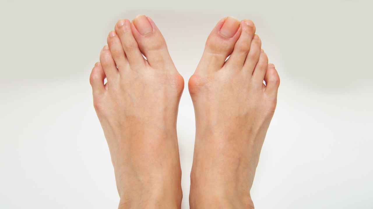 Bunions