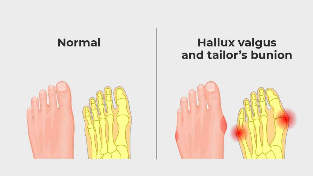 Hallux valgus and bunionette or tailor’s bunion