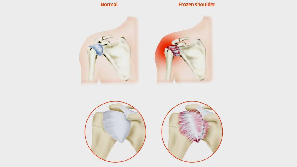 Comparison between normal and frozen shoulder