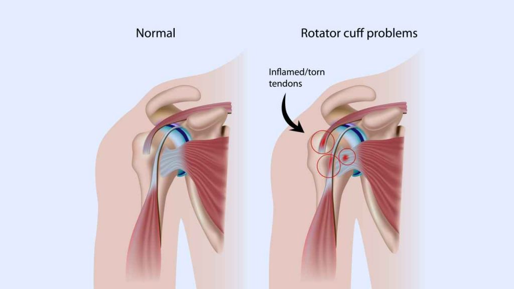 Rotator cuff problems