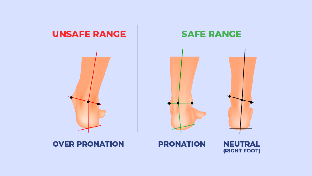 Figure 4. Pronation vs overpronation when walking
